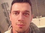 Ouch: Portuguese defender Jose Fonte posted this picture of his cut eye on Instagram